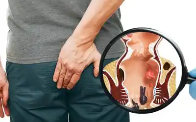 Blood Piles Treatment