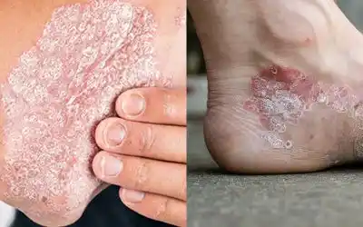 Skin Diseases Support